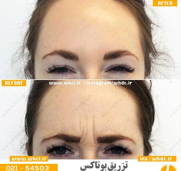 عکس بوتاکس صورت قبل و بعد