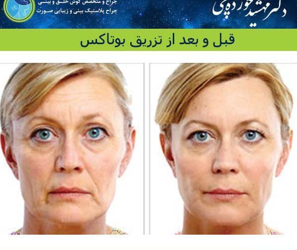 عکس بوتاکس صورت قبل و بعد