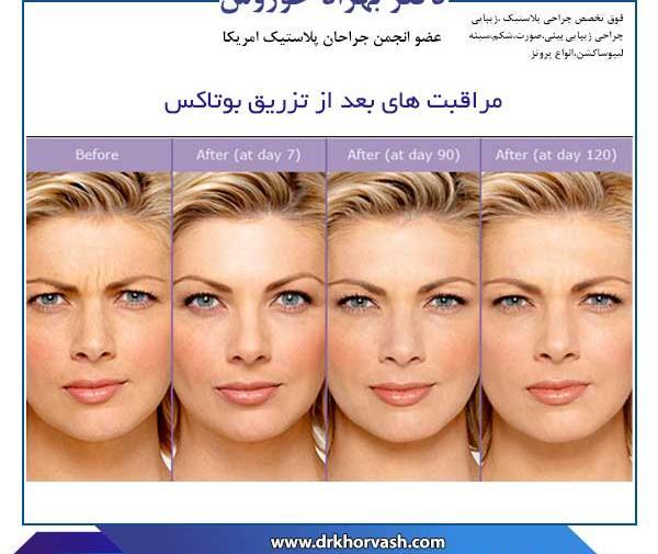 عکس بوتاکس صورت قبل و بعد