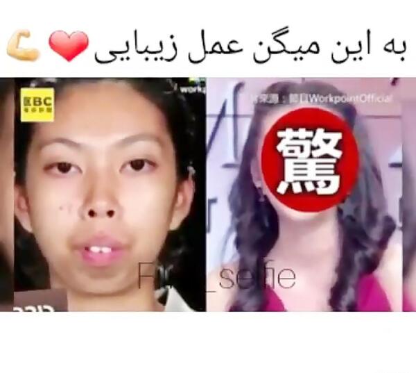 عکس لیسا قبل از عمل زیبایی