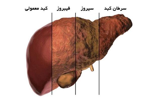 عکس کبد چرب انسان
