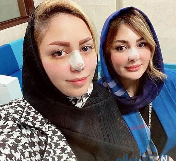 عکس نیوشا ضیغمی قبل از عمل بینی