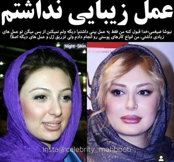 عکس نیوشا ضیغمی قبل از عمل بینی