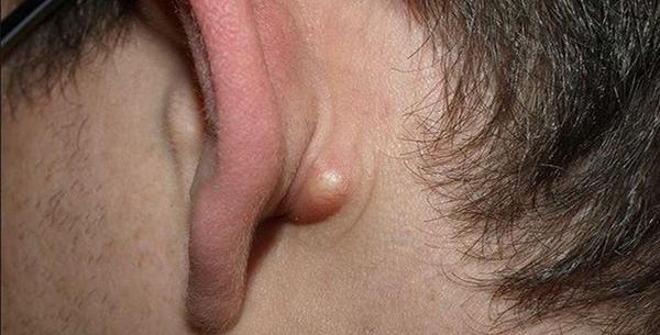 عکس کبودی زیر گلو