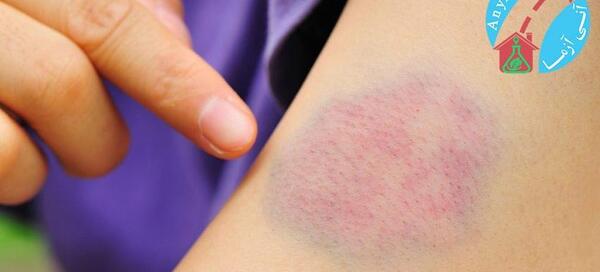 عکس کبودی دست بعد از سرم