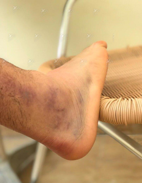 عکس پای کبود شده