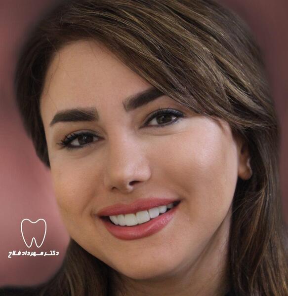 عکس لبخند کامپوزیت