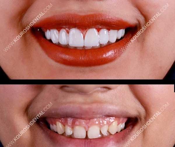 عکس لبخند کامپوزیت