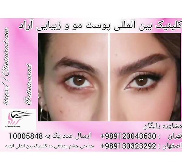 عکس چشم روباه