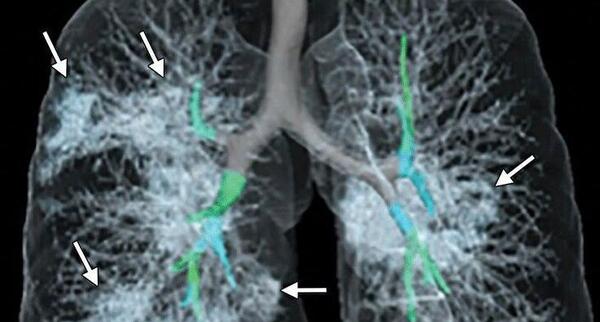عکس ریه کرونایی