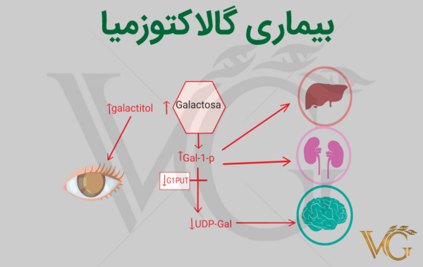 عکس بیماری گالاکتوزمی