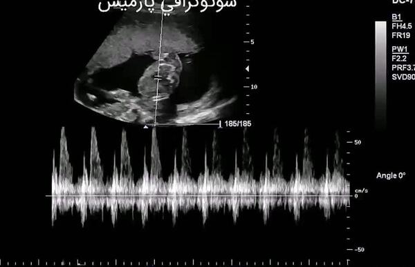 عکس ضربان قلب پسر