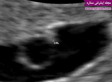 عکس قلب جنین در هفته ششم