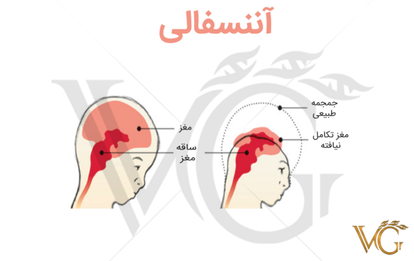 عکس نوزاد آنانسفالی