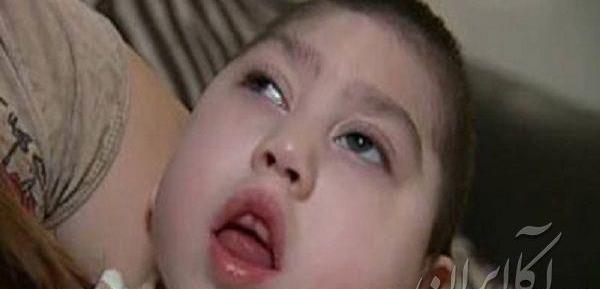 عکس نوزاد آنانسفالی