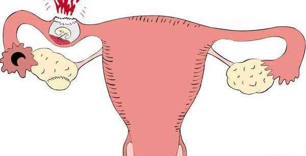 عکس بارداری خارج رحم