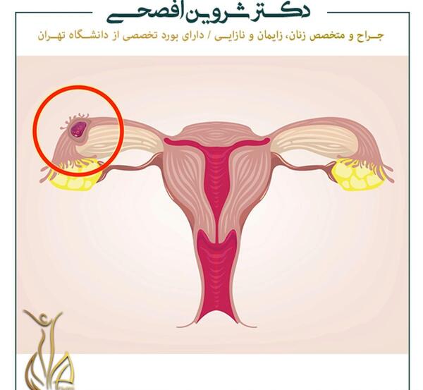 عکس بارداری خارج رحم