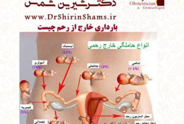 عکس بارداری خارج رحم