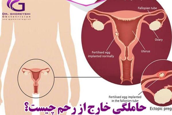 عکس بارداری خارج رحم