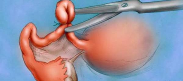عکس حلقه ضد بارداری