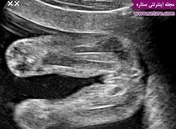 عکس جنین پسر هجده هفته