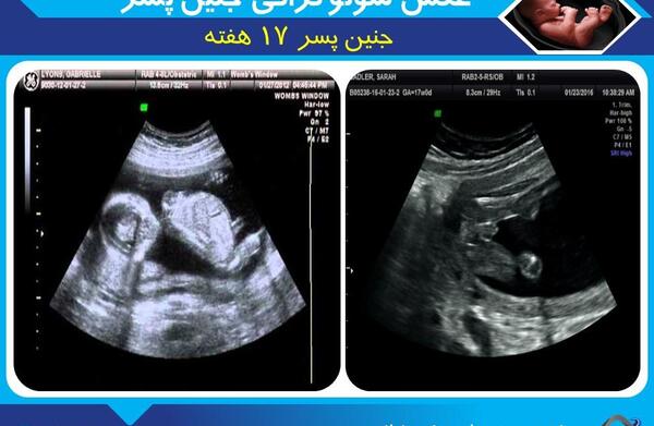 عکس جنین پسر هجده هفته