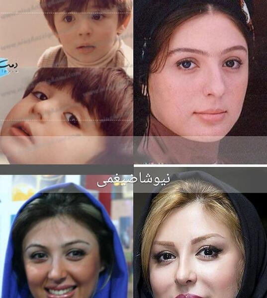 عکس قبل وبعدازعمل نیوشا ضیغمی