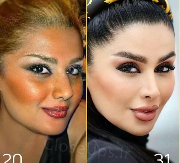 عکس قبل از عمل دنیا جهانبخت