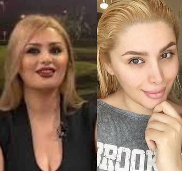 عکس قبل از عمل دنیا جهانبخت