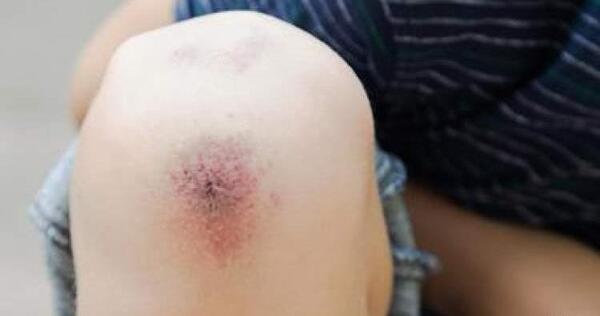 عکس زانوی کبود شده