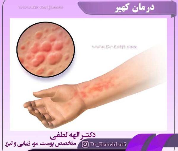 تناسلی عکس بیماری گال