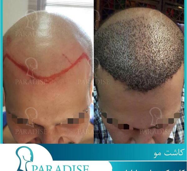 عکس قبل کاشت مو