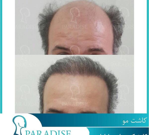 عکس قبل کاشت مو