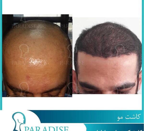 عکس قبل کاشت مو