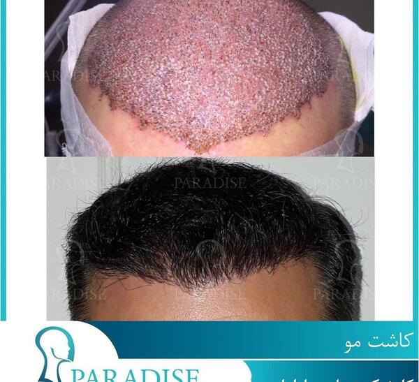 عکس قبل کاشت مو
