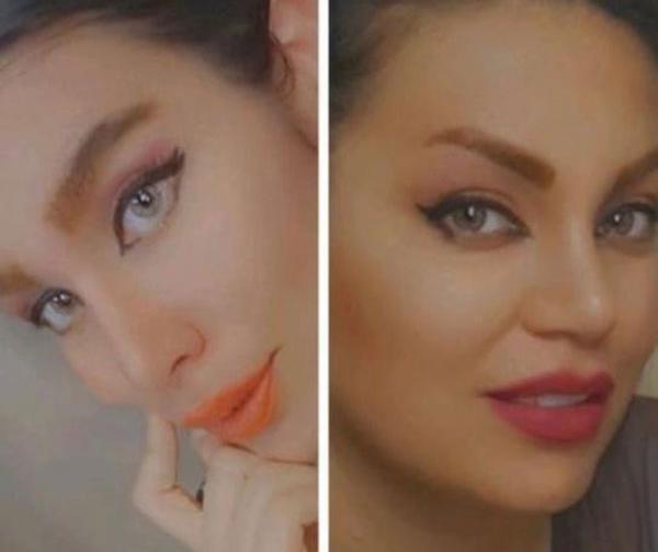 عکس کبودی چشم بعد از عمل بینی