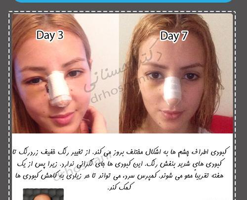 عکس کبودی چشم بعد از عمل بینی