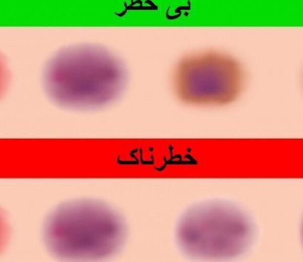 عکس کبودی های خطرناک