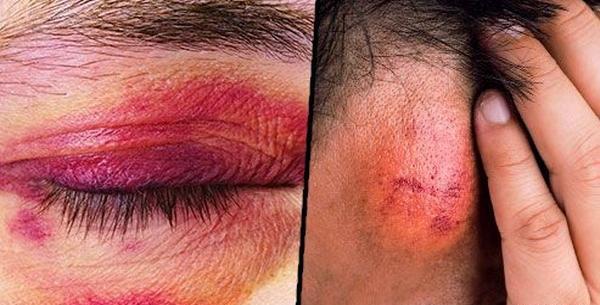عکس کبودی های خطرناک