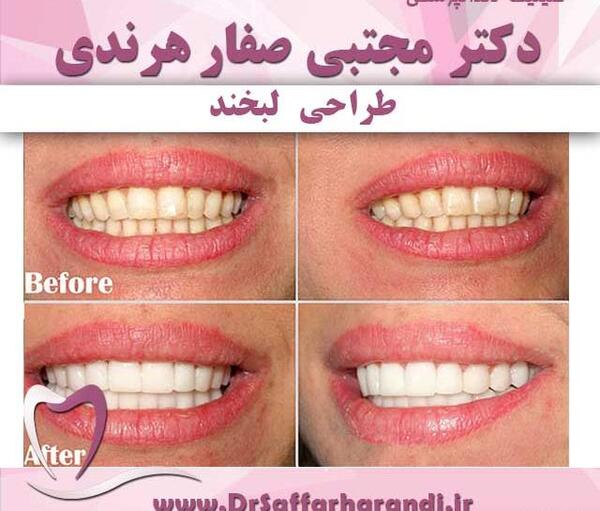 عکس لبخند دندان