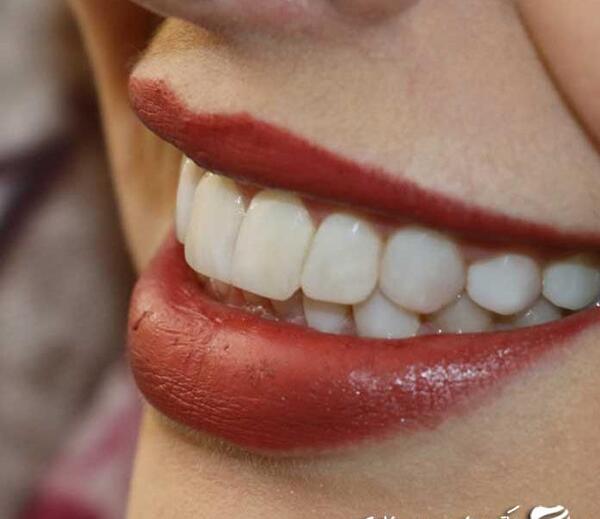 عکس لبخند دندان