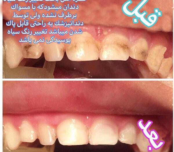 عکس سیاه شدن دندان کودک