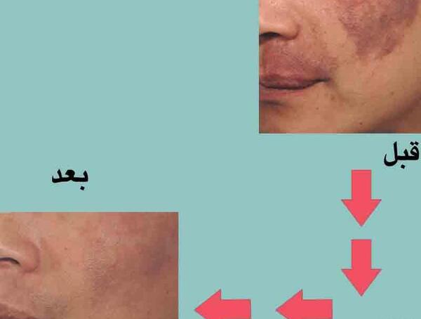 عکس ماه گرفتگی صورت