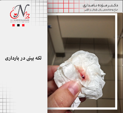 عکس لکه بینی در اوایل بارداری