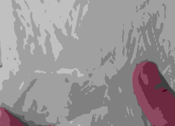 سقط جنین عکس لکه بینی در بارداری