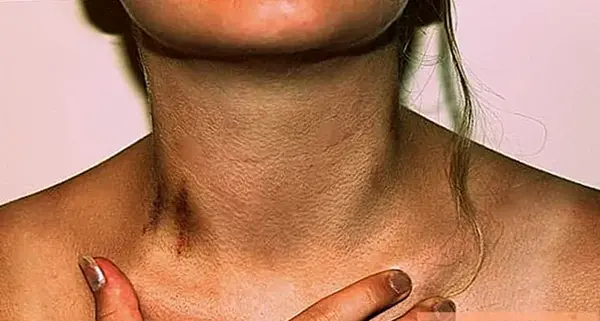 عکس عاشقانه کبودی گردن