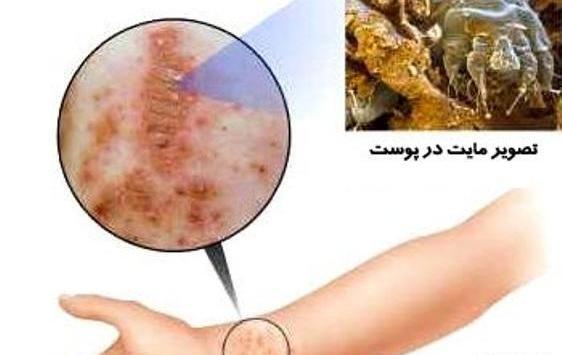 عکس های از بیماری گال