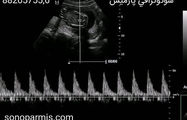 عکس ضربان قلب جنین دختر و پسر