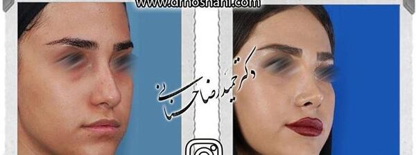 عکس سه بعدی قبل عمل بینی