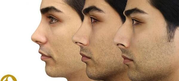 عکس سه بعدی قبل عمل بینی